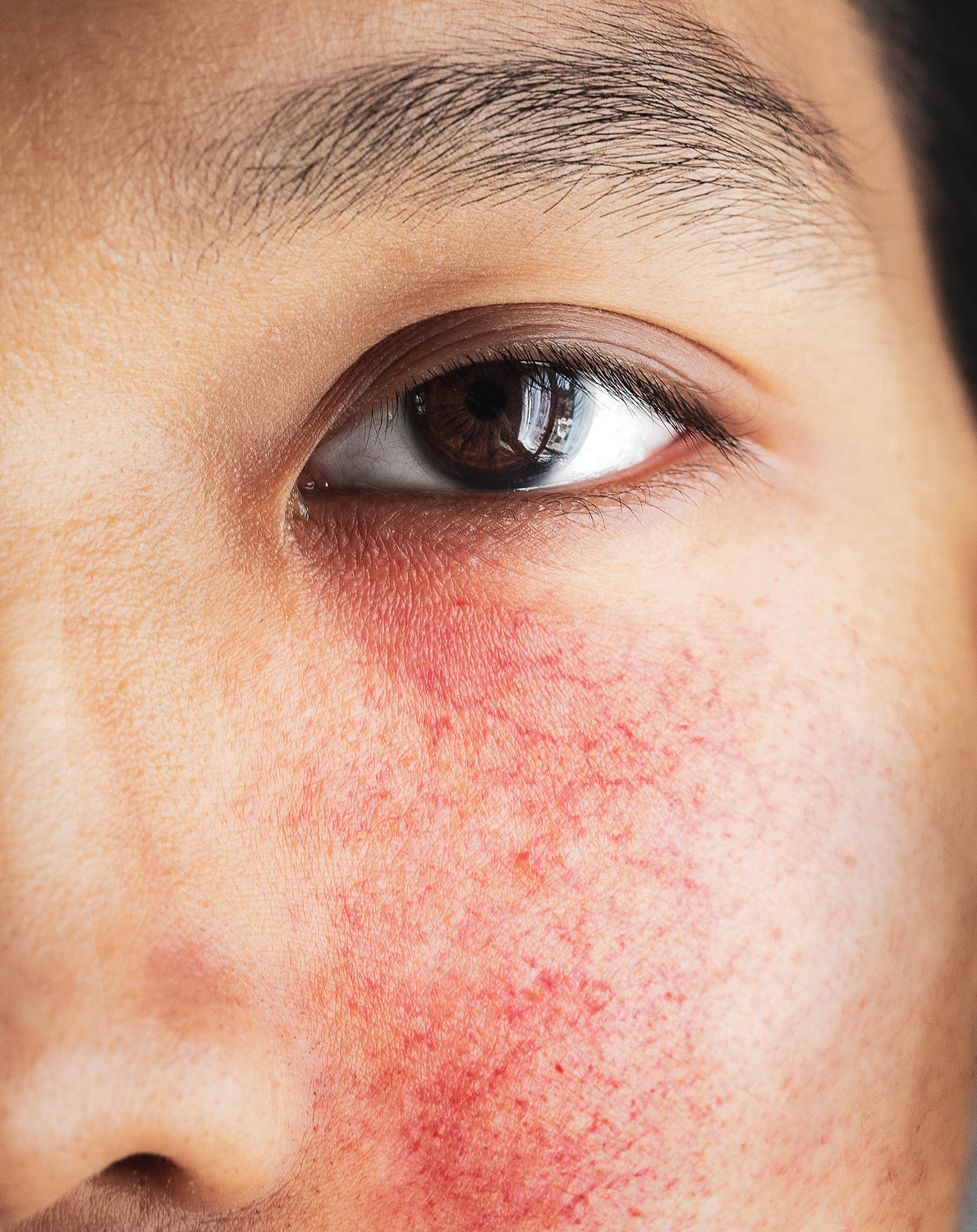 Rosacea