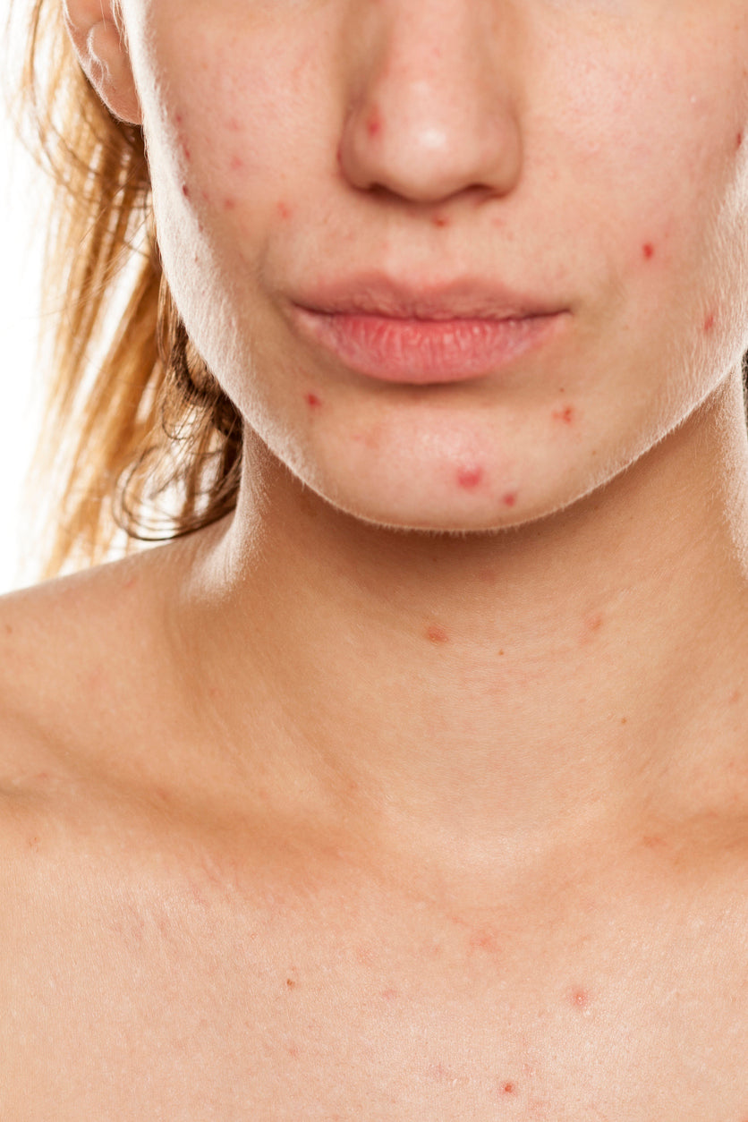 Acne advice
