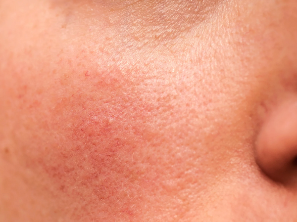 Rosazea behandeln: Ursachen, Symptome und moderne Therapieoptionen bei empfindlicher Haut