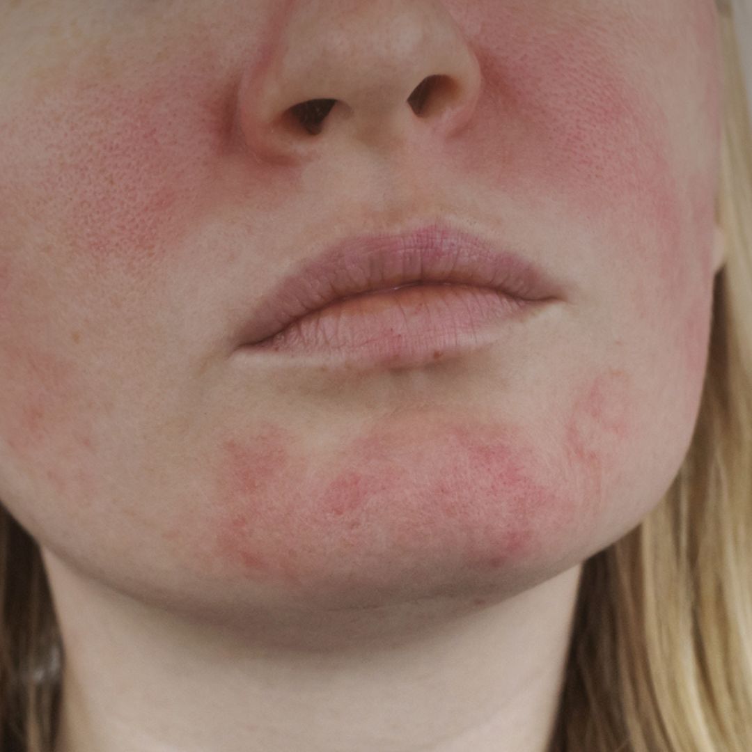 Periorale Dermatitis