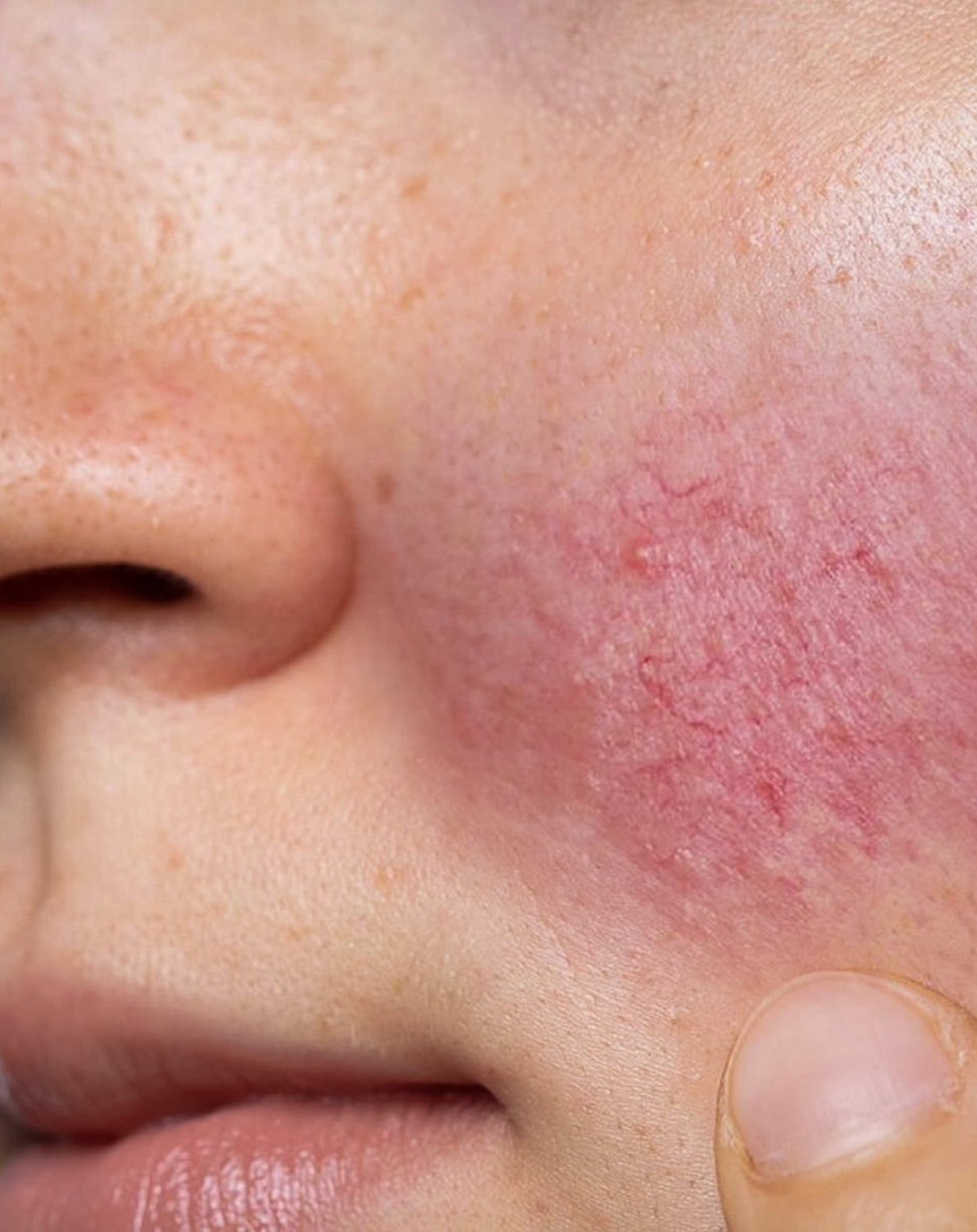 Eine Nahaufnahme einer Frau mit Rosazea auf ihrer Wange