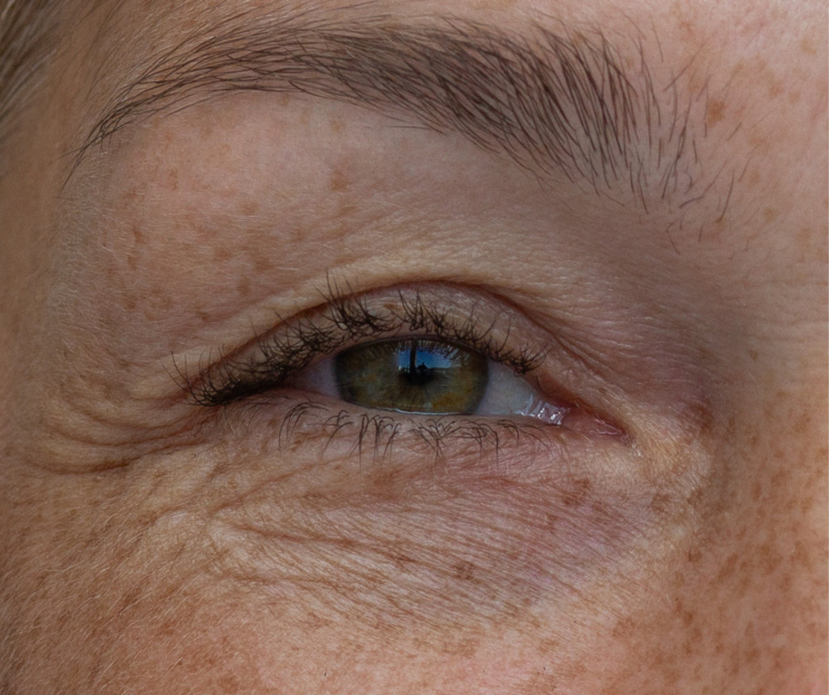 Upper eyelid lift
